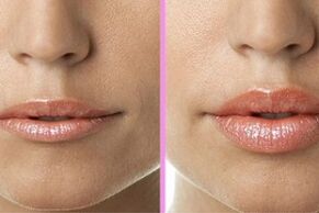 prima e dopo il restauro delle labbra